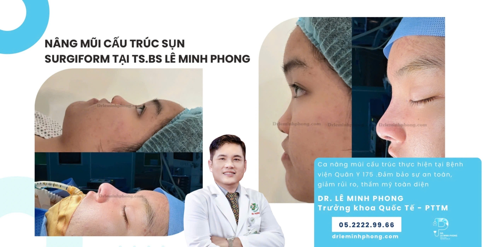 Mũi cấu trúc sụn SURGIFORM