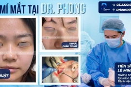 Mở Góc Mắt Trong Mini