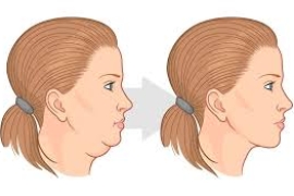 Hút Mỡ Nọng Cằm
