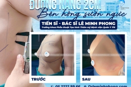 Quy trình nâng ngực đường bên hông sườn tại BV Quân Y 175 với TS.BS Lê Minh Phong
