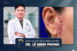 Sửa Sẹo Căng Da Mặt