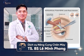 Chỉnh Sụp Mí Bẩm Sinh