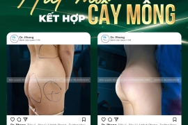 Hút mỡ kết hợp cấy mông