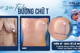 Treo ngực sa trễ đường chữ T