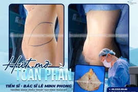 Hút Mỡ Toàn Phần An Toàn Tại BV 175
