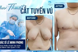 Cắt Tuyến Vú