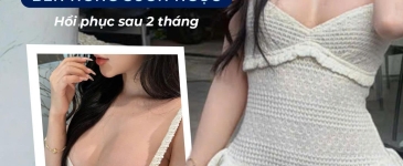 Đường nâng ngực bên hông sườn là gì? Xu hướng nâng ngực mới tại bệnh viện chính thống