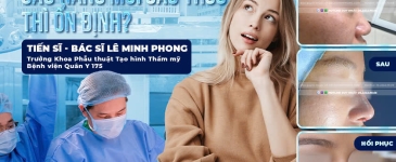 Bao Lâu Sau Nâng Mũi Cấu Trúc Thì Dáng Mũi Ổn Định?