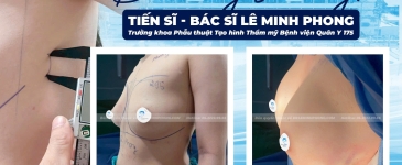 Đường Nâng 2cm Là Gì? Sự Thật Đằng Sau Công Nghệ Nâng Ngực Ít Xâm Lấn