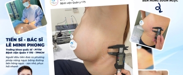 5 đường mổ nâng ngực phổ biến hiện nay và sự khác biệt của đường nâng bên hông sườn