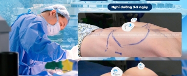 Đường Nâng 2cm Có Đặt Được Túi Ngực Kích Thước Lớn Không?