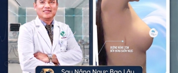 Sau Nâng Ngực Bao Lâu Được Nằm Nghiêng?