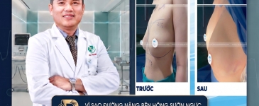 Vì Sao Đường Nâng Bên Hông Sườn Ngực Được Nhiều Khách Hàng Lựa Chọn?