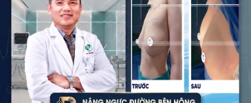 Nâng Ngực Đường Bên Hông Sườn Có Để Lại Sẹo Không? 
