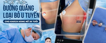 Nâng vòng 1 bằng đường nâng bên hông sườn kết hợp đường quầng loại bỏ u tuyến