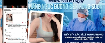 Review Sau 60 Ngày Nâng Ngực Đường Bên Hông Sườn