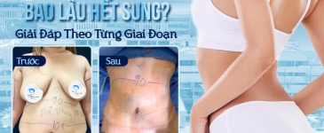 Sau Hút Mỡ Toàn Phần Bao Lâu Hết Sưng? Giải Đáp Theo Từng Giai Đoạn