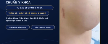 Hướng Dẫn Phục Hồi Sau Nâng Mũi Chuẩn Y Khoa Từ Bác Sĩ Chuyên Khoa