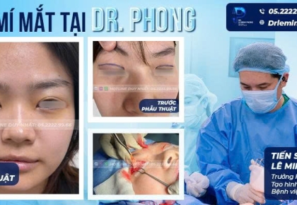 Mở Góc Mắt Trong Mini