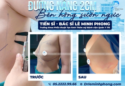 Đường Nâng 2cm Là Gì? Sự Thật Đằng Sau Công Nghệ Nâng Ngực Ít Xâm Lấn