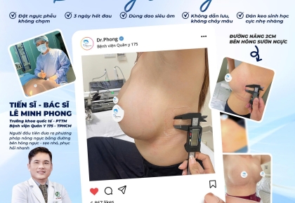 5 đường mổ nâng ngực phổ biến hiện nay và sự khác biệt của đường nâng bên hông sườn