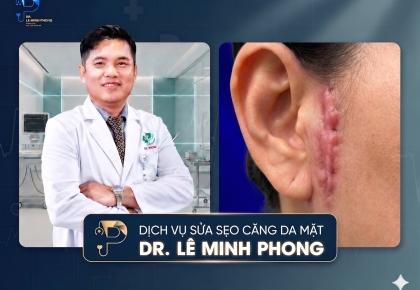 Sửa Sẹo Căng Da Mặt