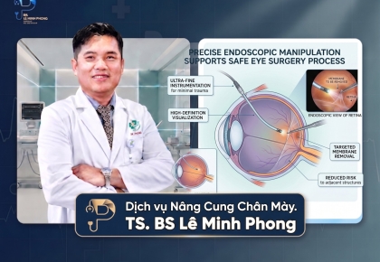 Nâng Cung Chân Mày