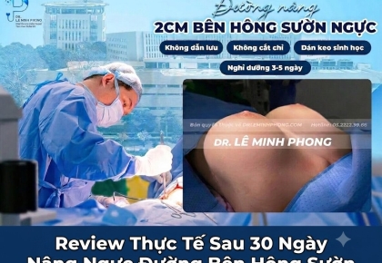 Review Thực Tế Sau 30 Ngày Nâng Ngực Đường Bên Hông Sườn