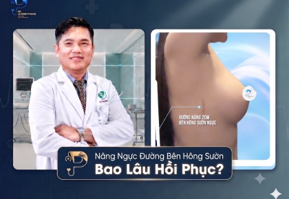 Nâng Ngực Đường Bên Hông Sườn Bao Lâu Hồi Phục?