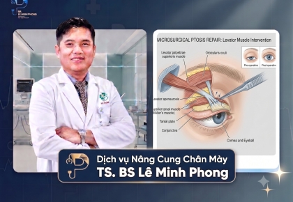 Chỉnh Sụp Mí Bẩm Sinh