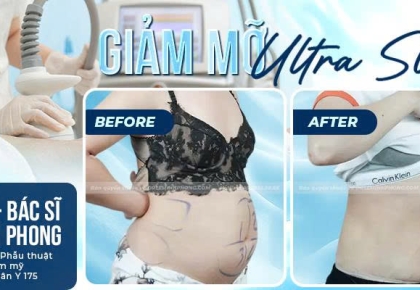 Giảm Mỡ ULtra Slim