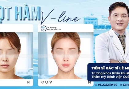 Gọt Hàm V-Line