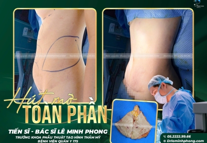 Hút Mỡ Bụng Toàn Phần