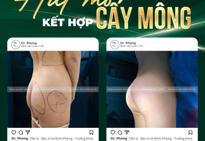 Hút mỡ kết hợp cấy mông