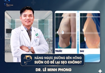 Nâng Ngực Đường Bên Hông Sườn Có Để Lại Sẹo Không? 