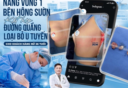 Nâng vòng 1 bằng đường nâng bên hông sườn kết hợp đường quầng loại bỏ u tuyến