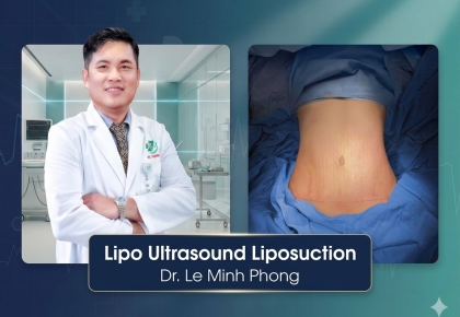 Hút Mỡ Lipo Ultrasound