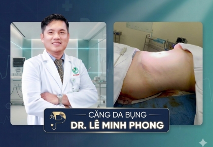 Căng Da Bụng