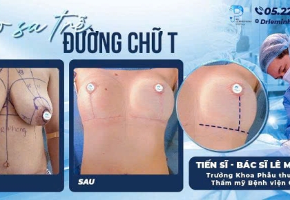 Treo ngực sa trễ đường chữ T