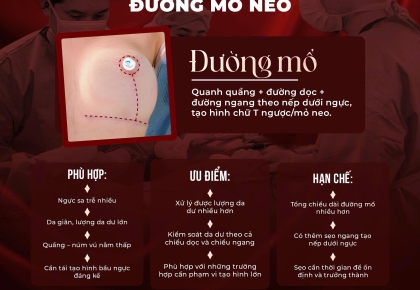 Treo sa trễ ngực là gì? Tìm hiểu 3 đường treo sa trễ phổ biến