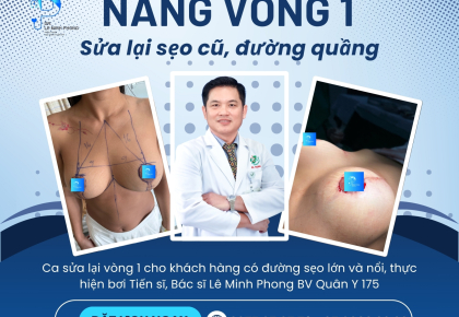 Nâng ngực sa trễ & thu nhỏ sẹo cũ đường quầng 