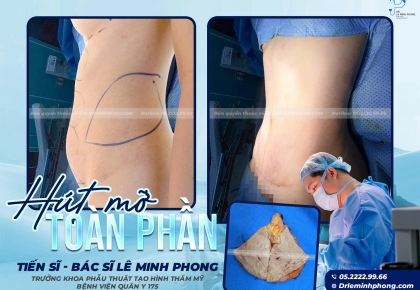 Hút Mỡ Toàn Phần An Toàn Tại BV 175