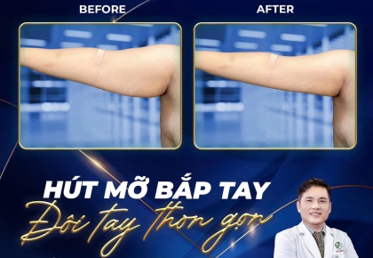 Hút Mỡ Tay