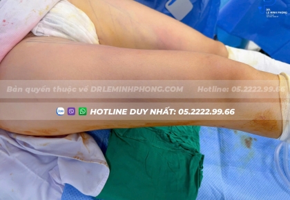 Hút Mỡ Đùi