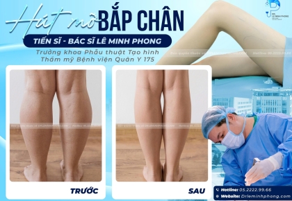 Hút Mỡ Bắp Chân