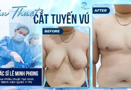 Cắt Tuyến Vú