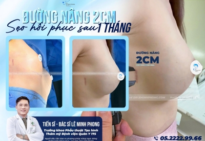 Ưu điểm nổi bật của đường nâng ngực bên hông sườn: sẹo nhỏ, phục hồi nhanh, giấu sẹo khéo