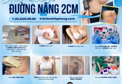 Ưu điểm nổi bật của đường nâng ngực bên hông sườn: sẹo nhỏ, phục hồi nhanh, giấu sẹo khéo