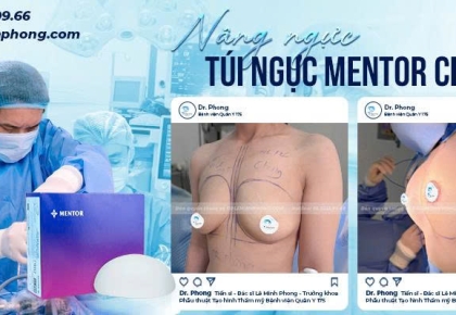 Nâng Ngực Mentor Thường