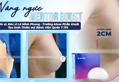 Nâng Ngực Mentor Boots